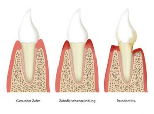 Parodontologie Köln